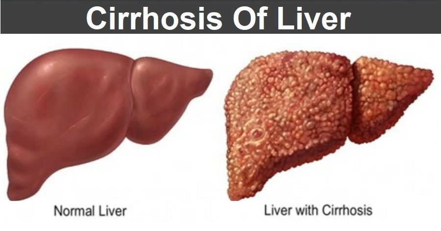 Home Remedies for Cirrhosis Of Liver